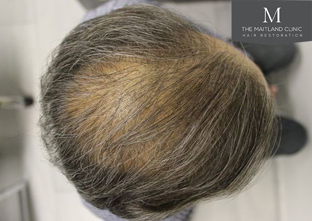 4010 grafts by FUT