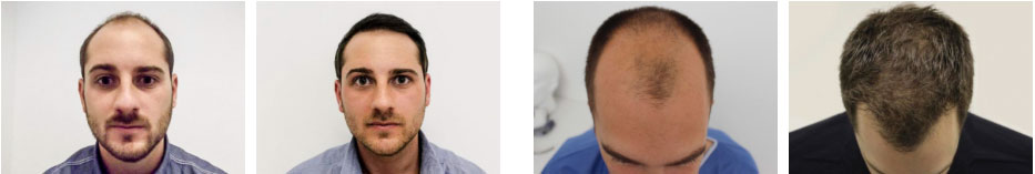 Hair transplant cardiff before and after photos