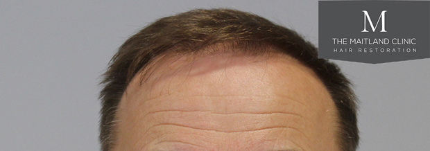 3009 grafts by FUT