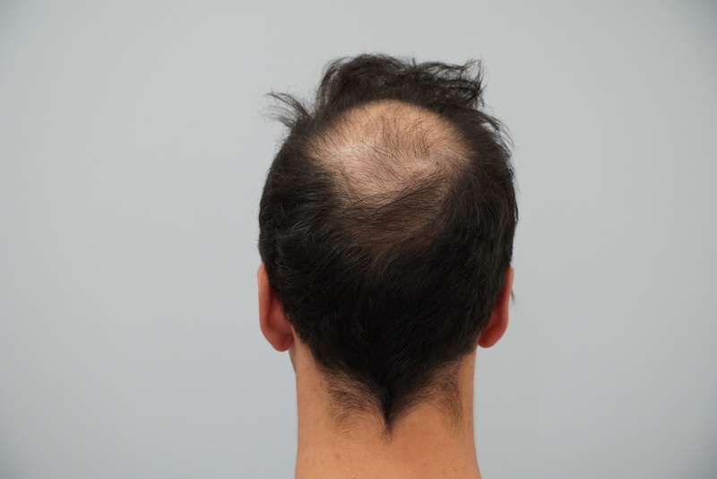 Does an FUE hair transplant leave scars? + 5 Common FUE Questions