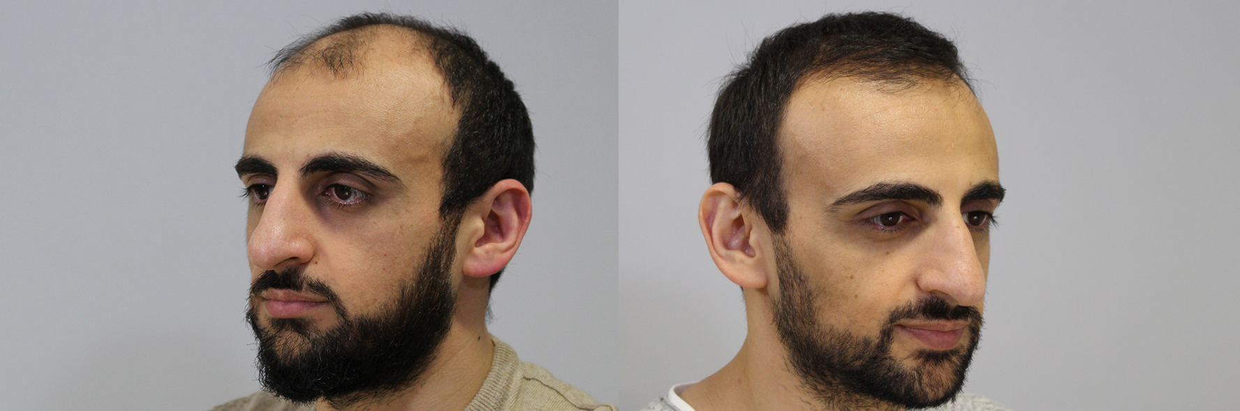 Before and after hair transplant photos with fuller hair growth from FUT