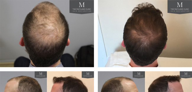 FUT hair transplant results