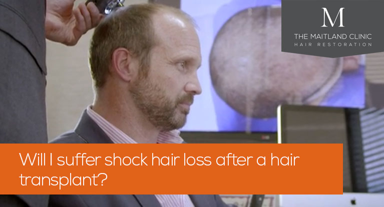 Will I suffer shock hair loss after a hair transplant?