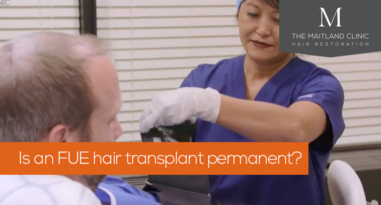 Is an FUE hair transplant permanent