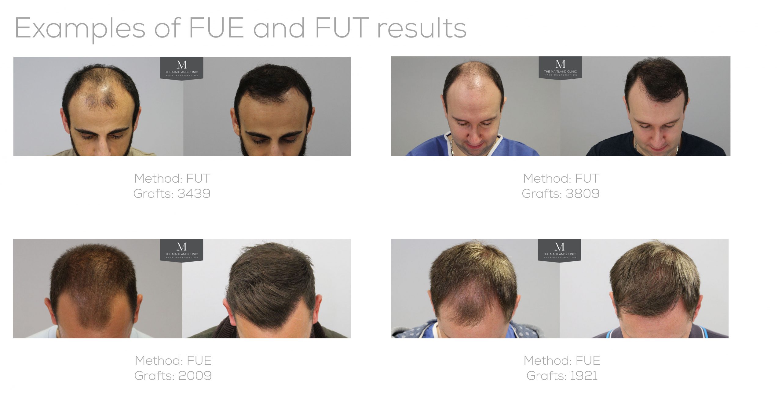 The difference between FUE and FUT hair transplant