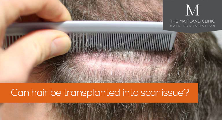 Can hair be transplanted onto scar tissue?