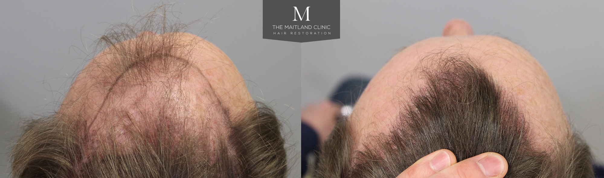 Natural looking hairline after hair transplant surgery