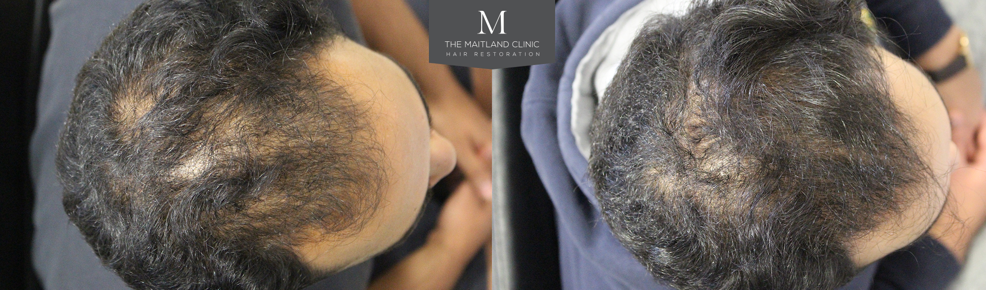 Before and after PRP treatment The Maitland Clinic