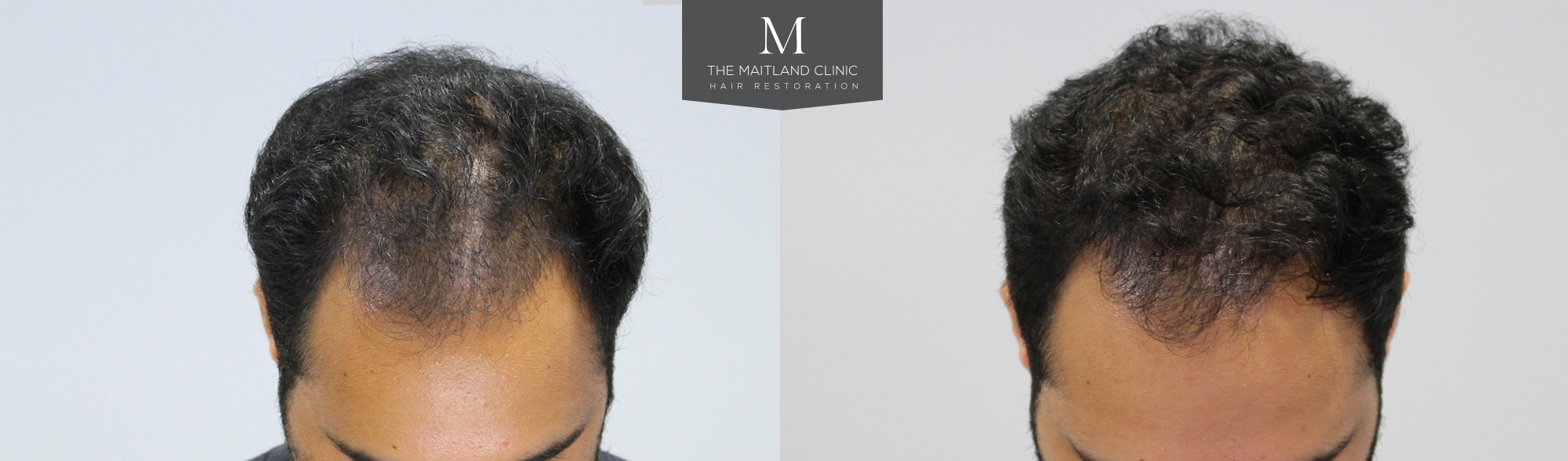 Before and after PRP treatment The Maitland Clinic