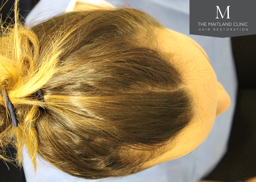 2150 grafts by FUT