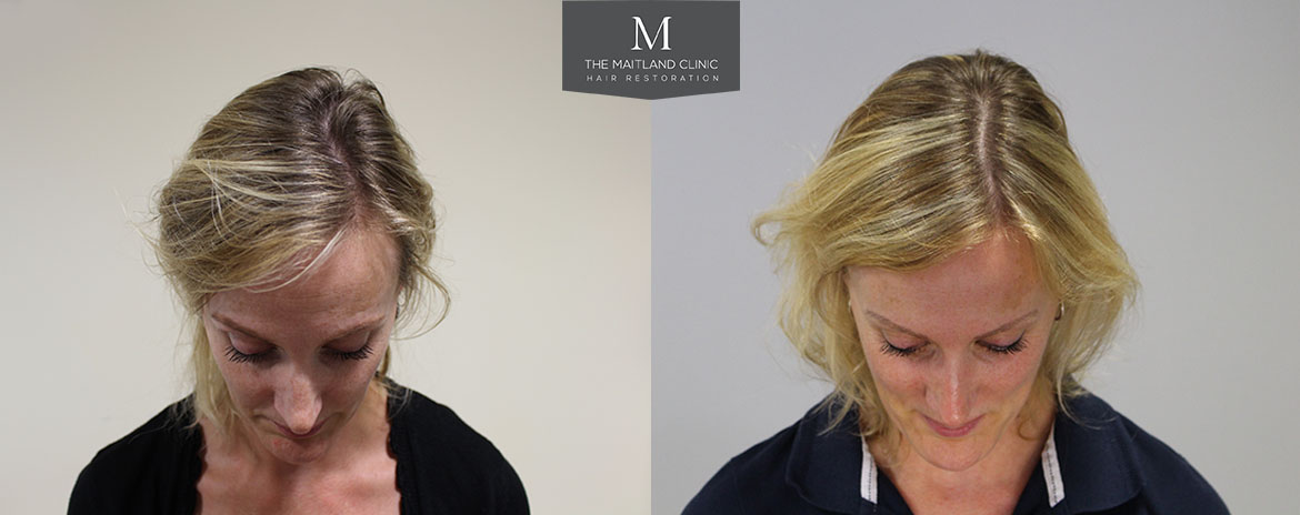 Before and after PRP treatment for hair loss