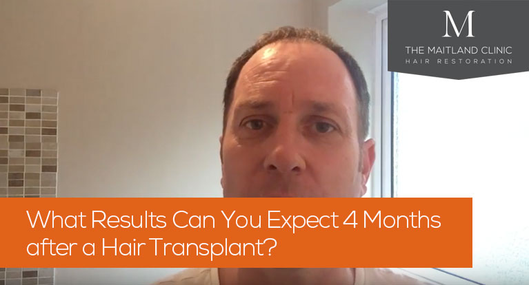 I Had a Hair Transplant 12 month results shown  Jack Lawrence