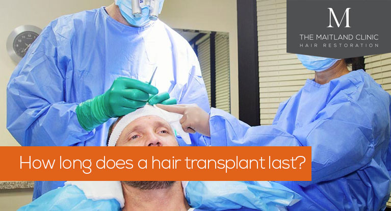 How long does a hair transplant last?