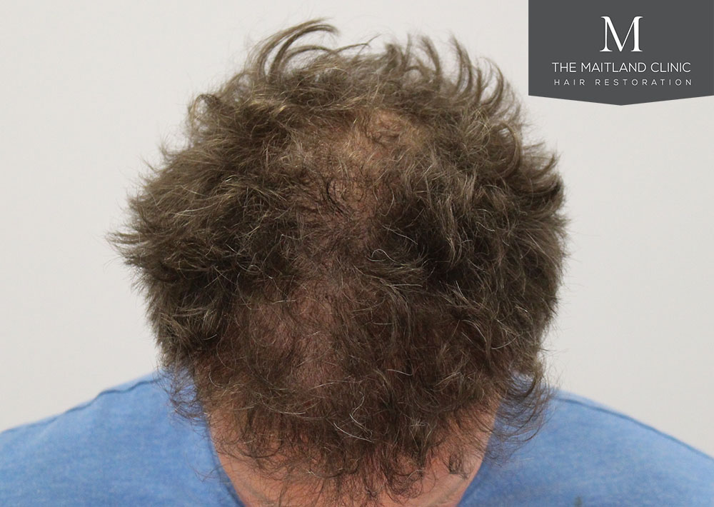 1611 grafts hair transplant repair surgery