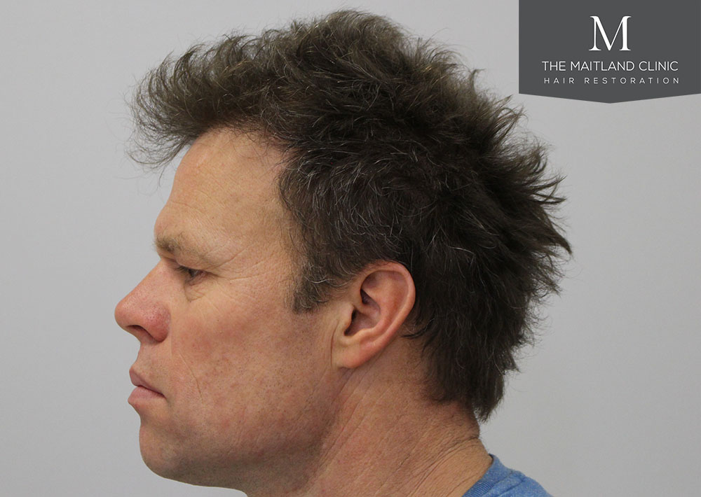 1611 grafts hair transplant repair surgery