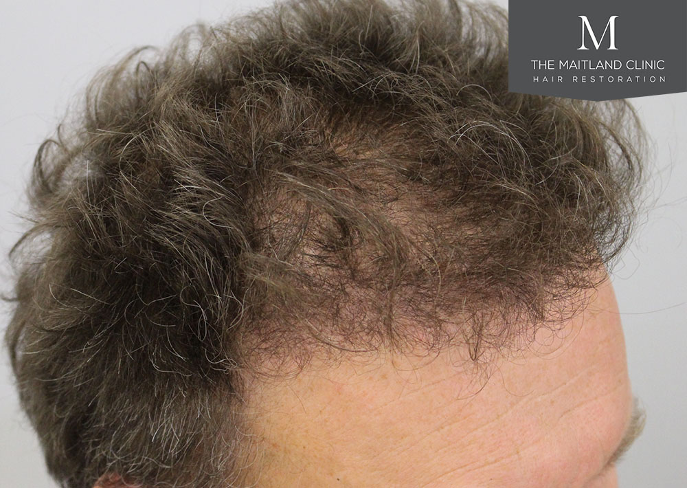 1611 grafts hair transplant repair surgery