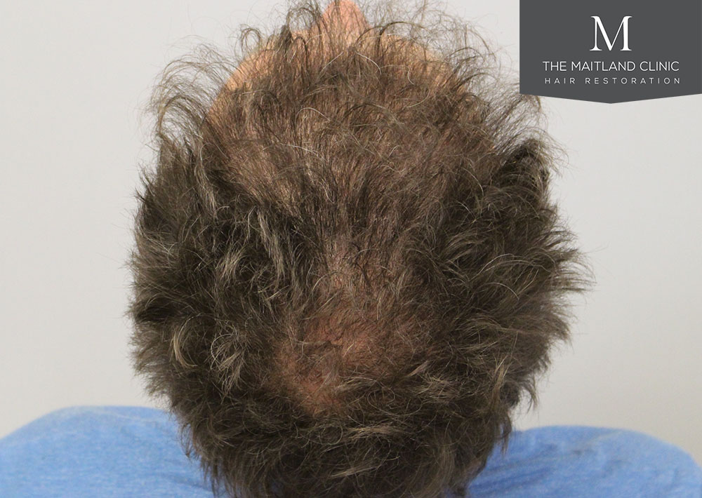1611 grafts hair transplant repair surgery