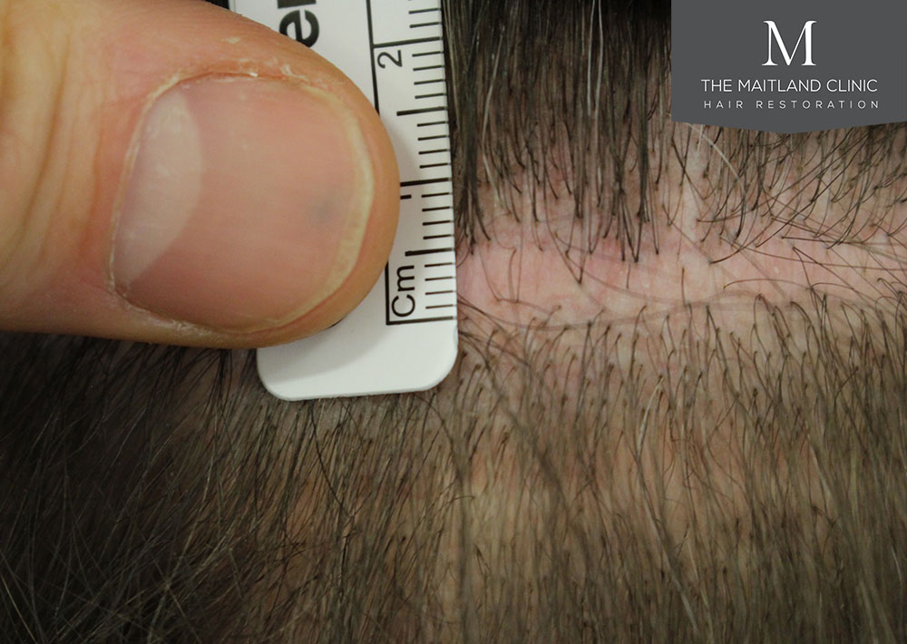 1611 grafts hair transplant repair surgery