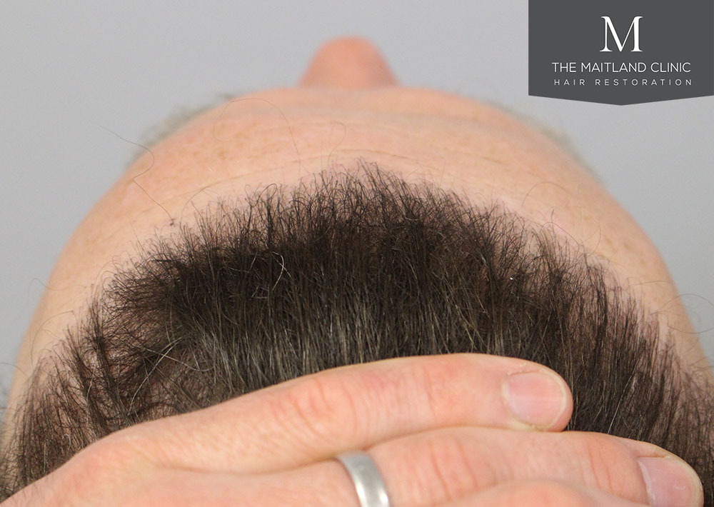 1611 grafts hair transplant repair surgery