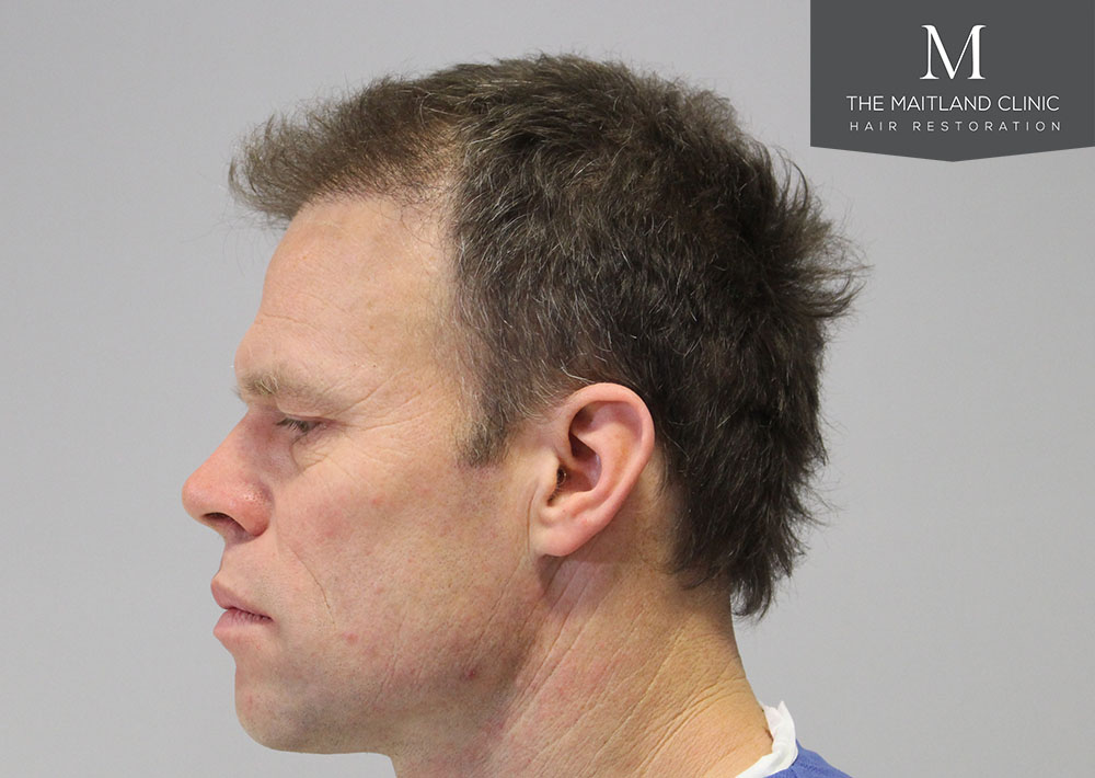 1611 grafts hair transplant repair surgery