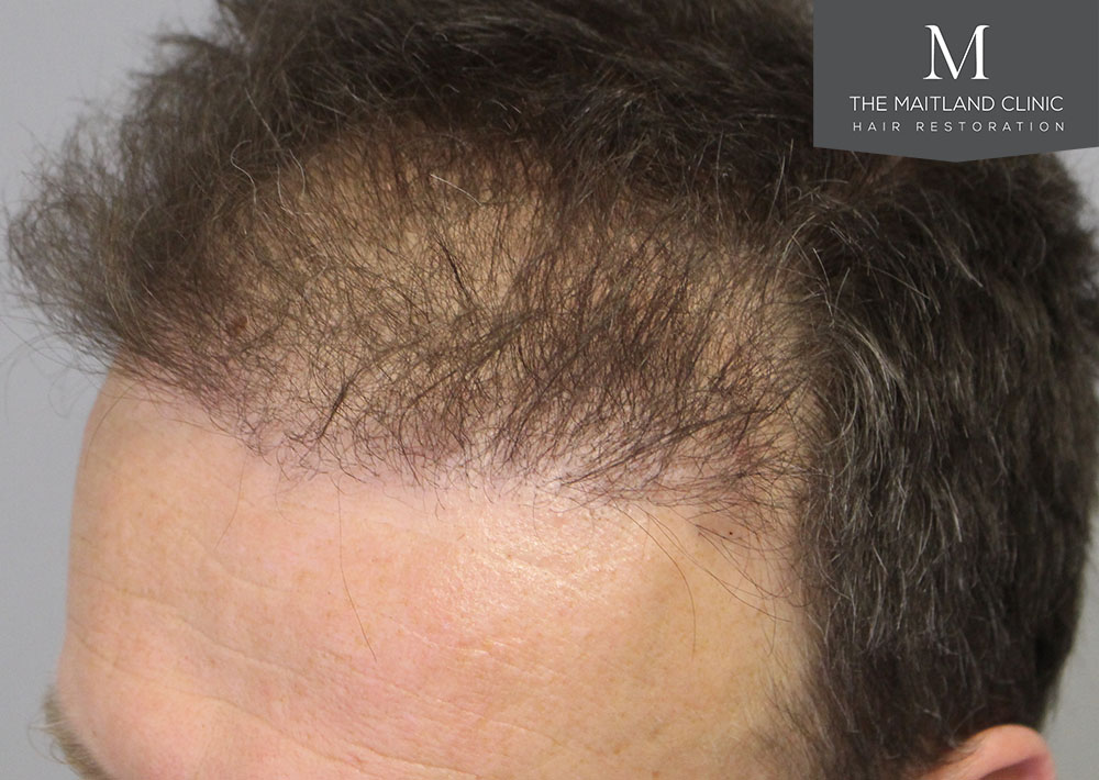 1611 grafts hair transplant repair surgery