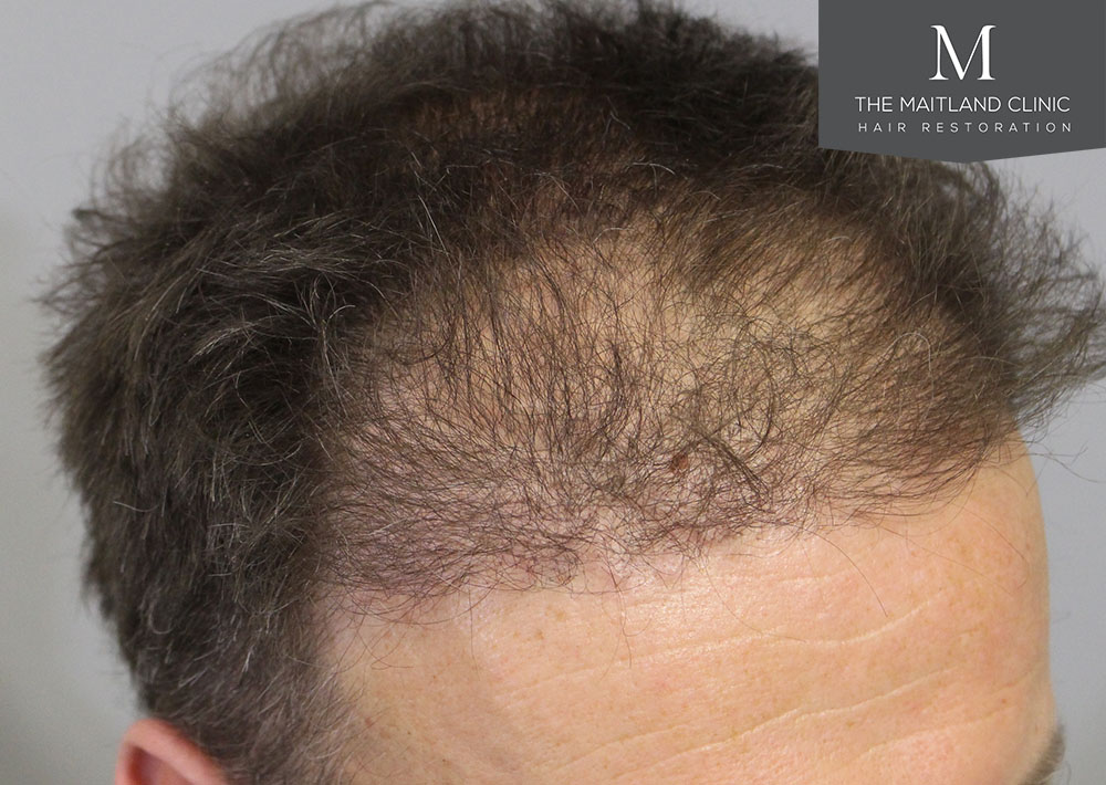 1611 grafts hair transplant repair surgery