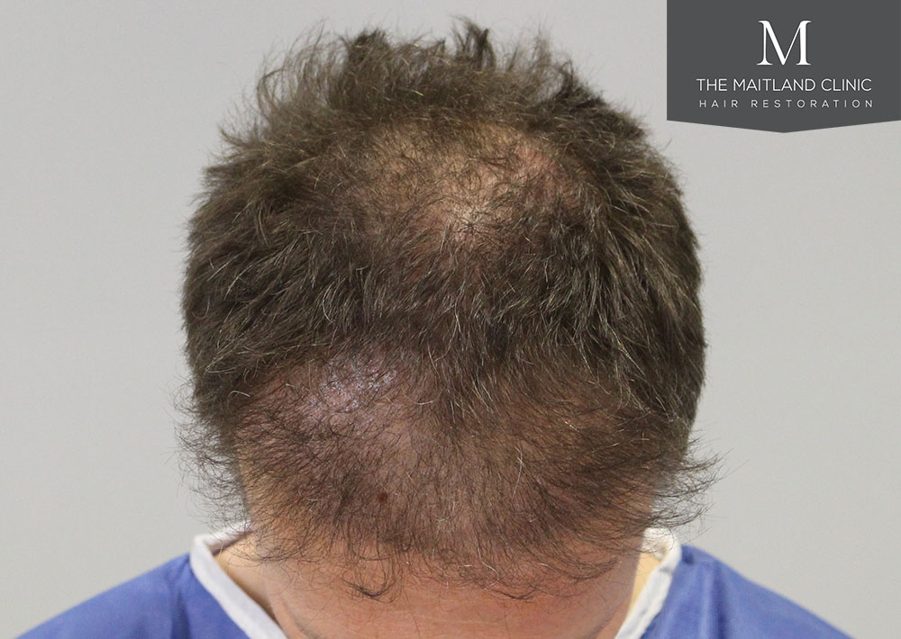 1611 grafts hair transplant repair surgery