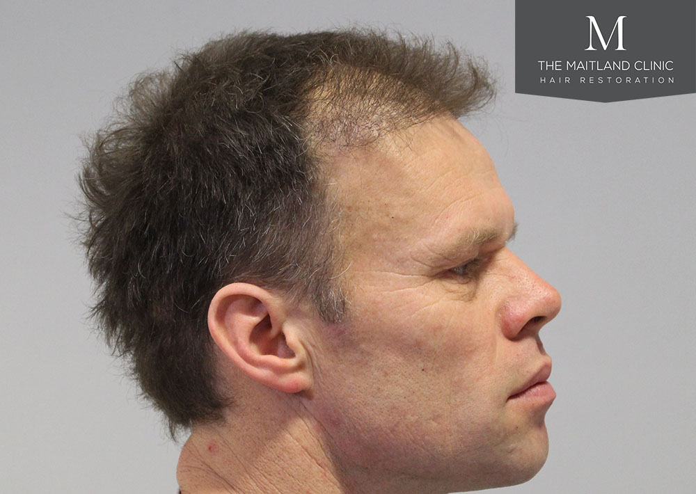 1611 grafts hair transplant repair surgery