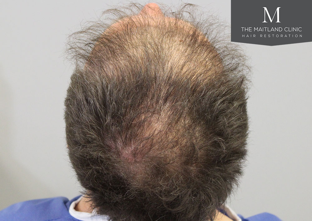 1611 grafts hair transplant repair surgery