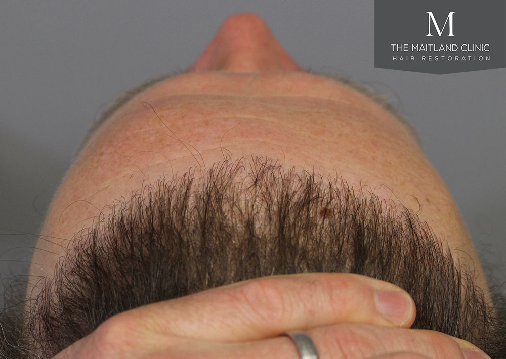 1611 grafts hair transplant repair surgery