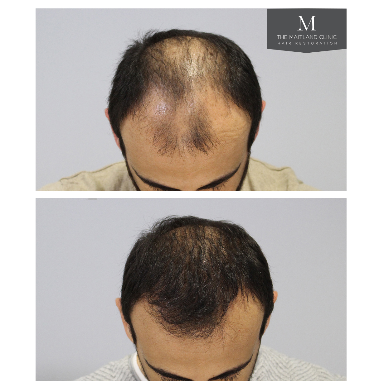 Before and after FUT hair transplant