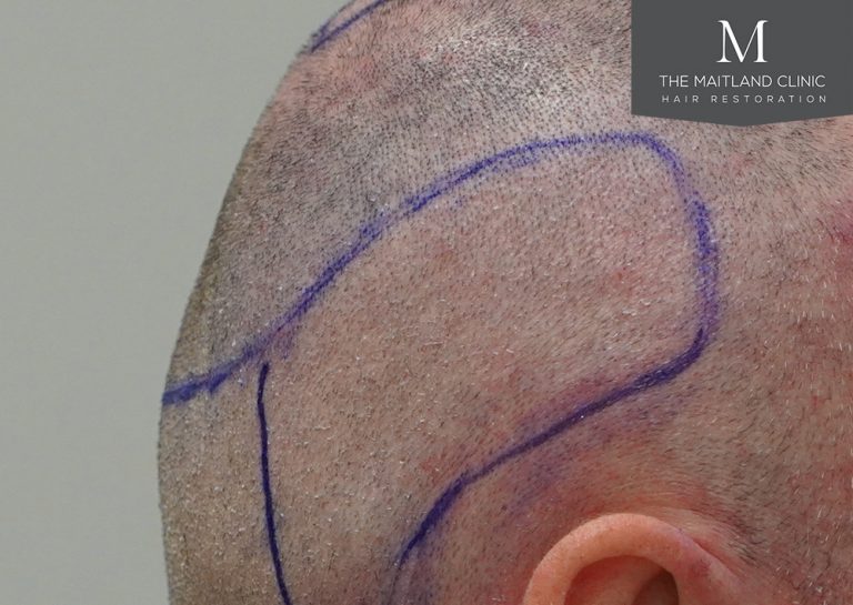 scars transplant grafts