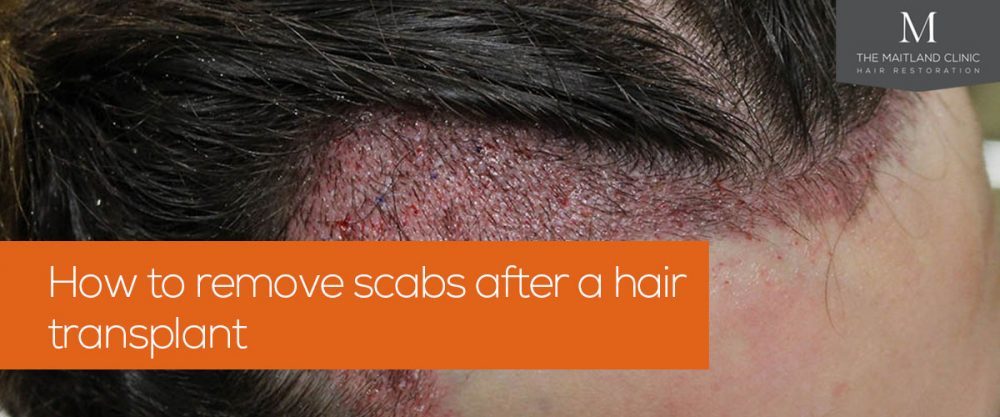 How to remove scabs after a hair transplant?