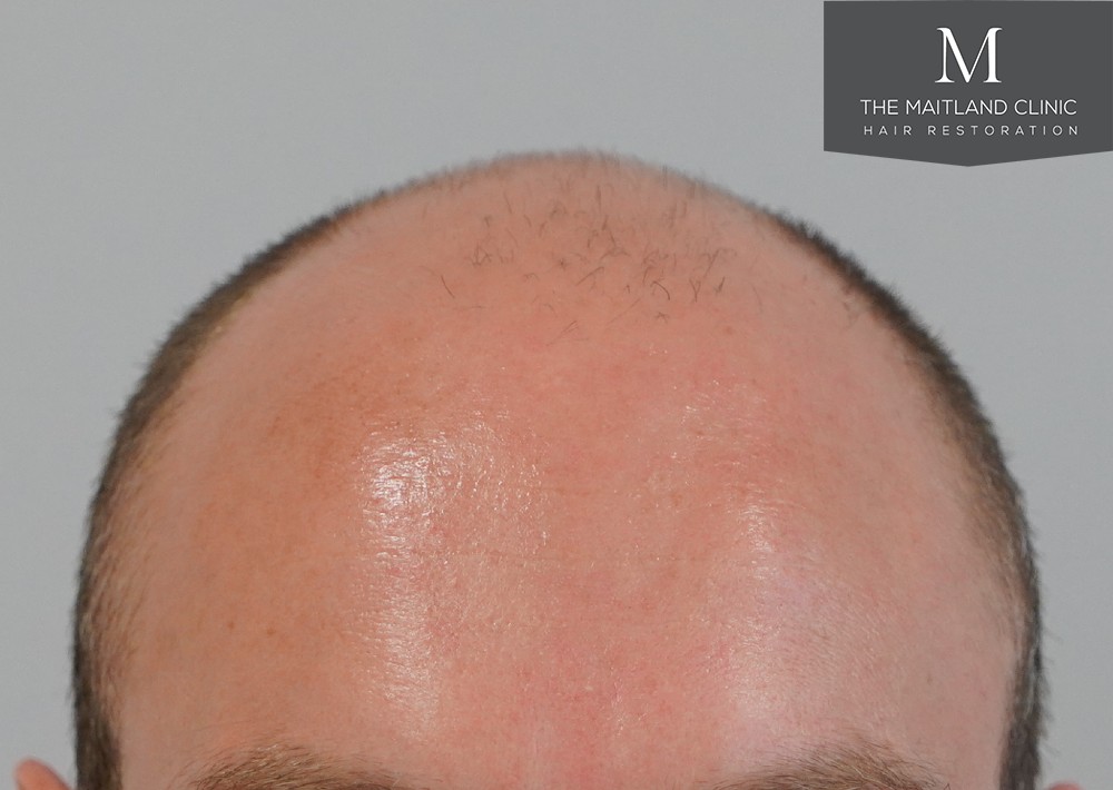 6 months results – 2081 grafts by FUE