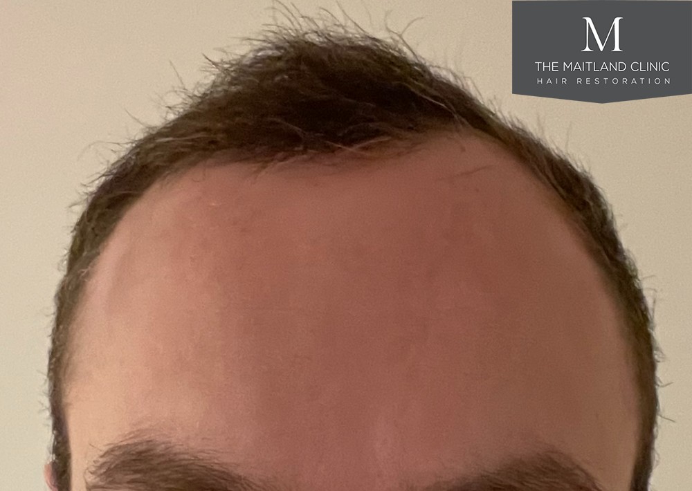 6 months results – 2081 grafts by FUE