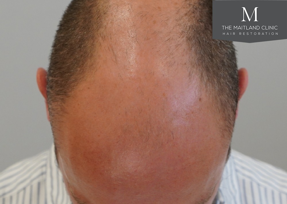 6 months results – 2081 grafts by FUE