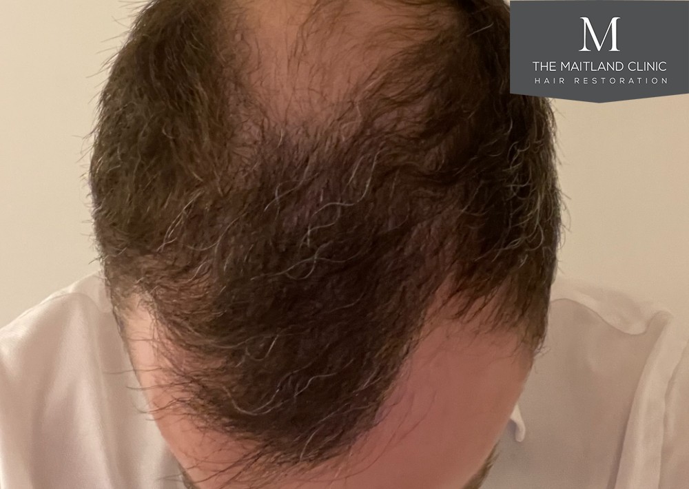 6 months results – 2081 grafts by FUE