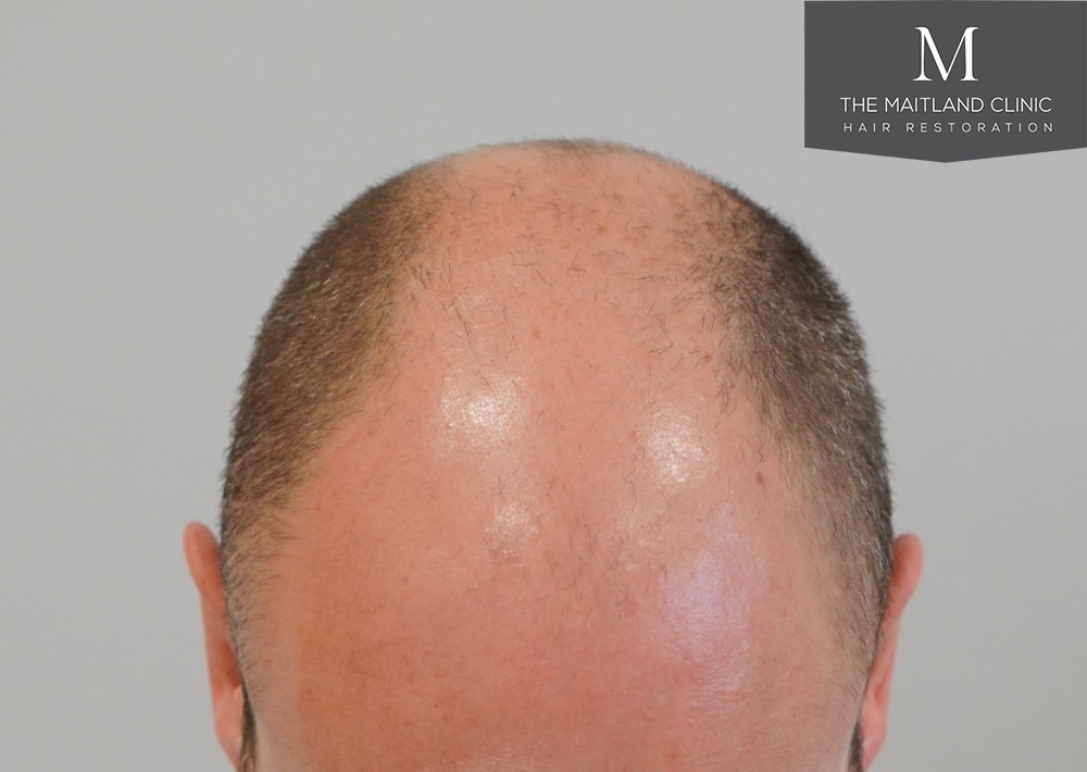 6 months results – 2081 grafts by FUE