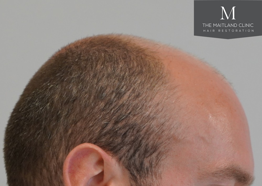 6 months results – 2081 grafts by FUE