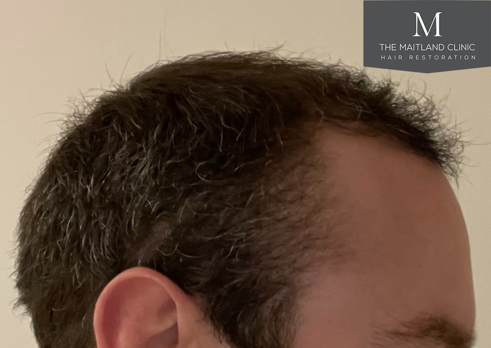 6 months results – 2081 grafts by FUE