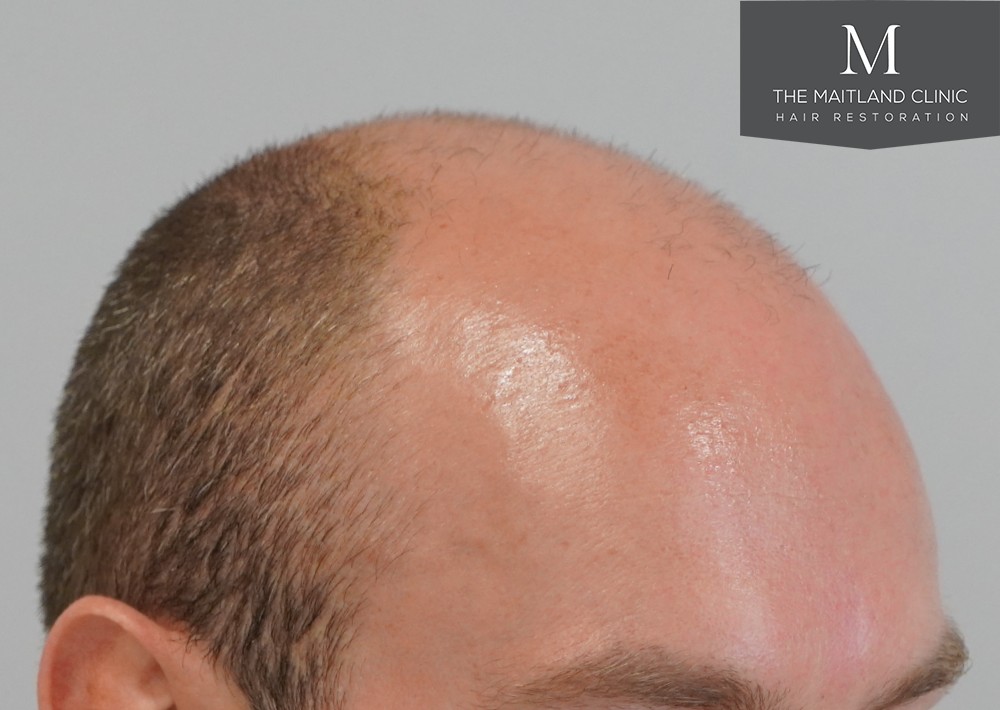 6 months results – 2081 grafts by FUE