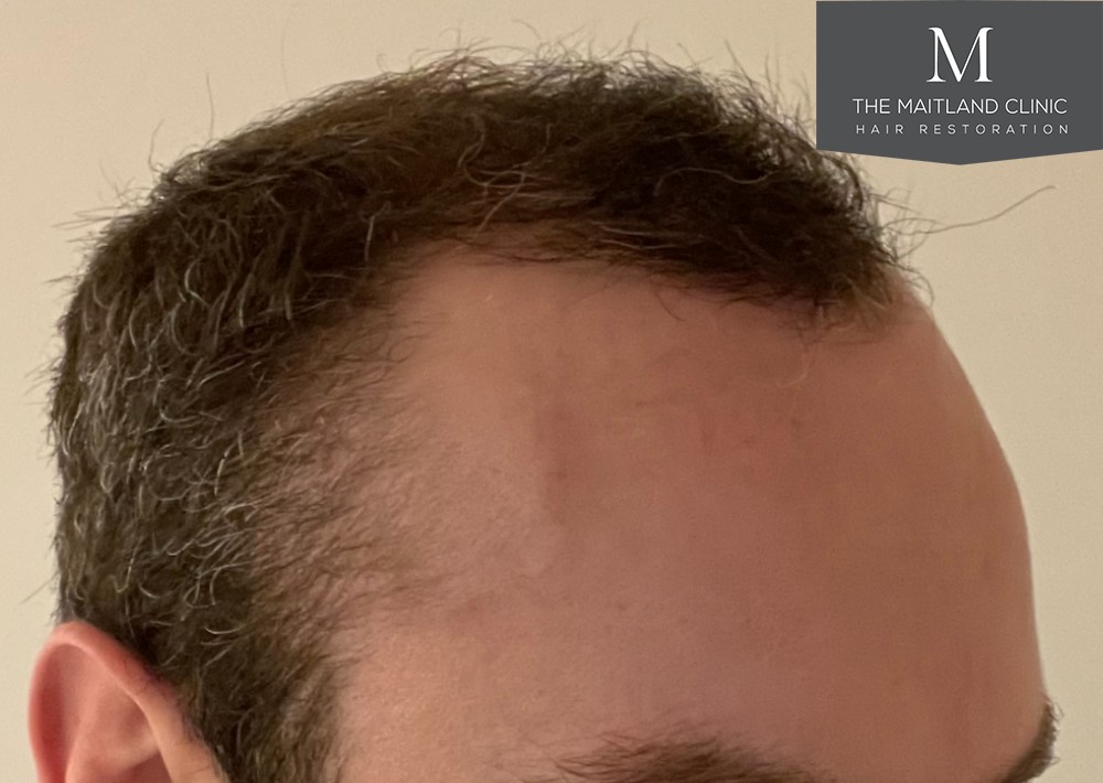 6 months results – 2081 grafts by FUE
