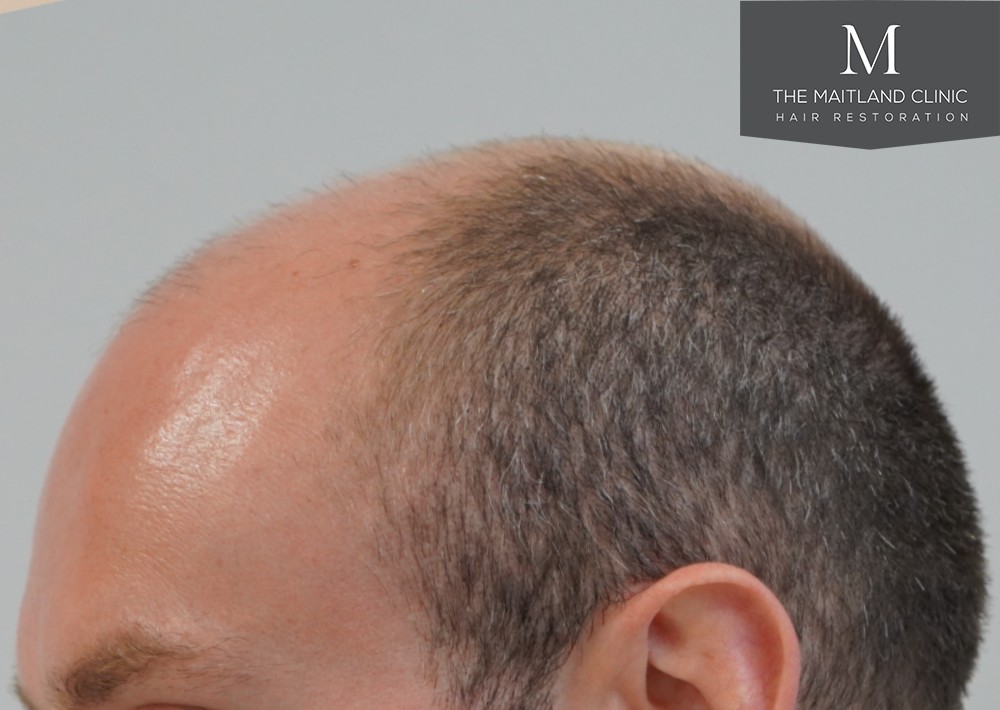 6 months results – 2081 grafts by FUE