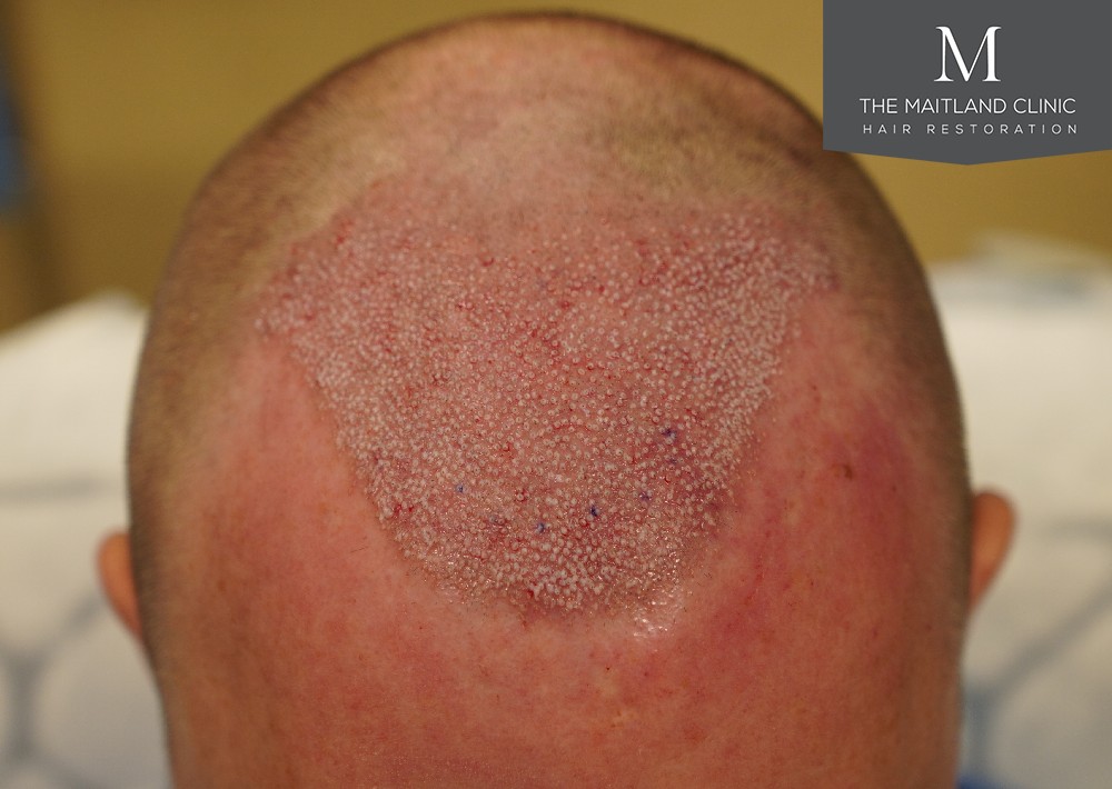 Important general principles to consider before proceeding with a hair transplant