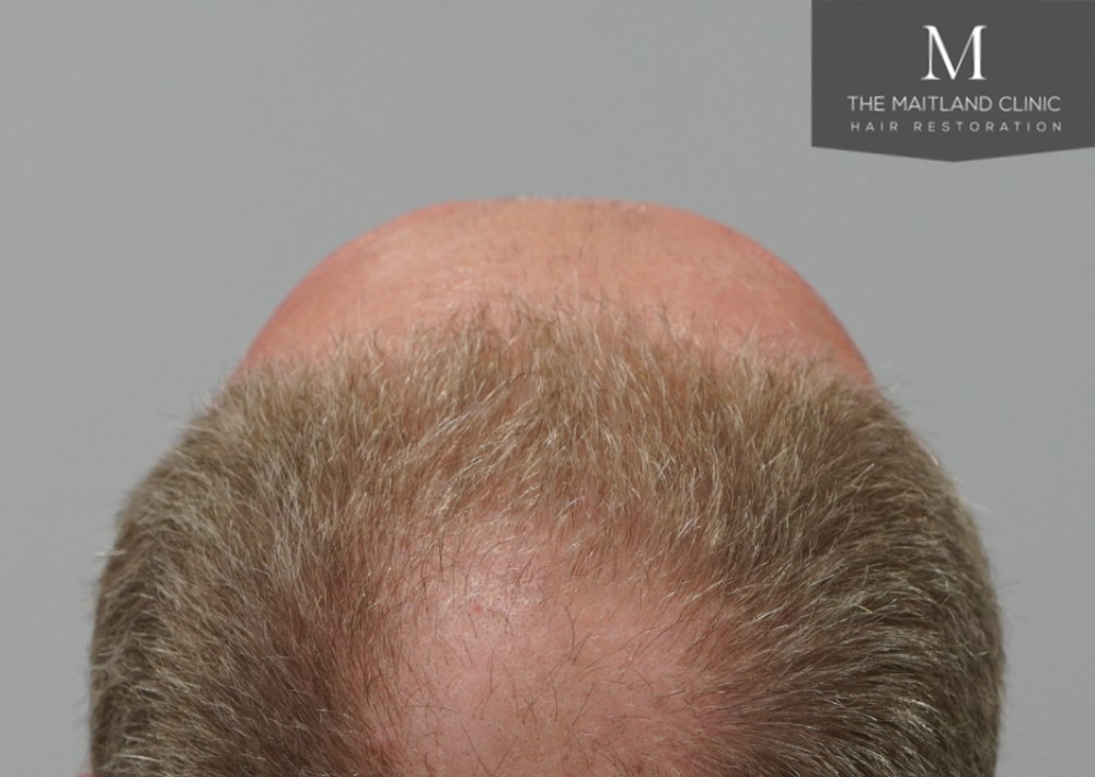 3589 grafts by FUT