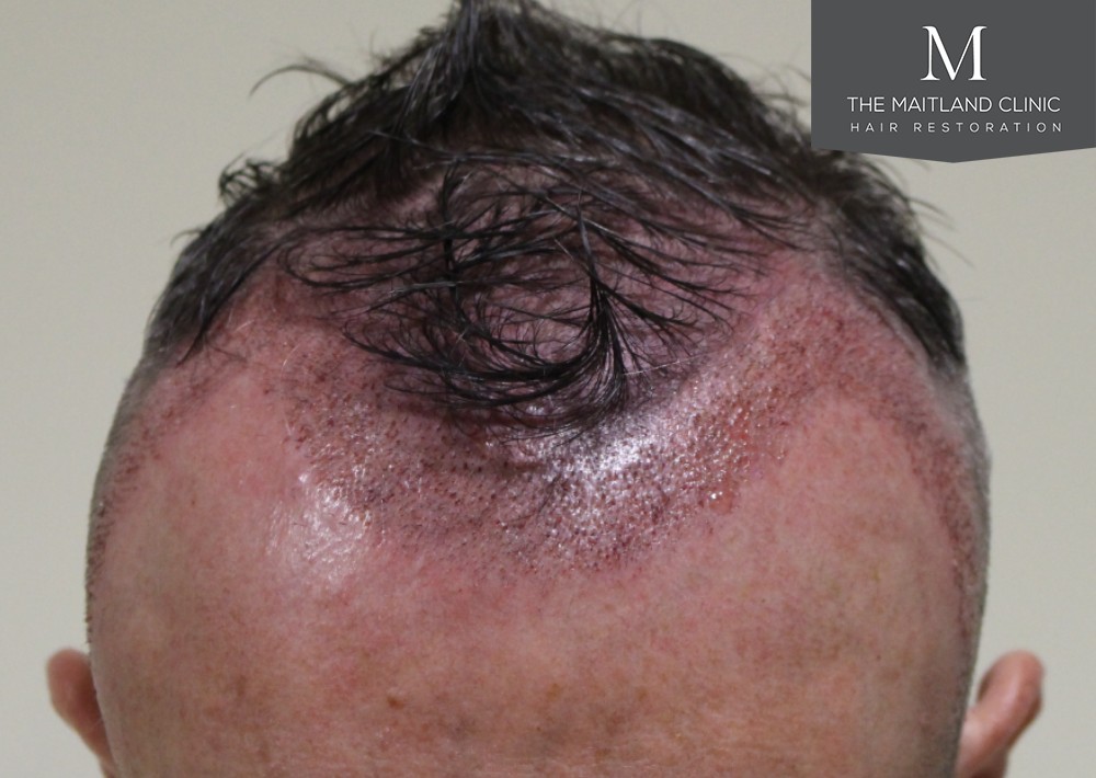 3487 grafts by FUE over 2 procedures