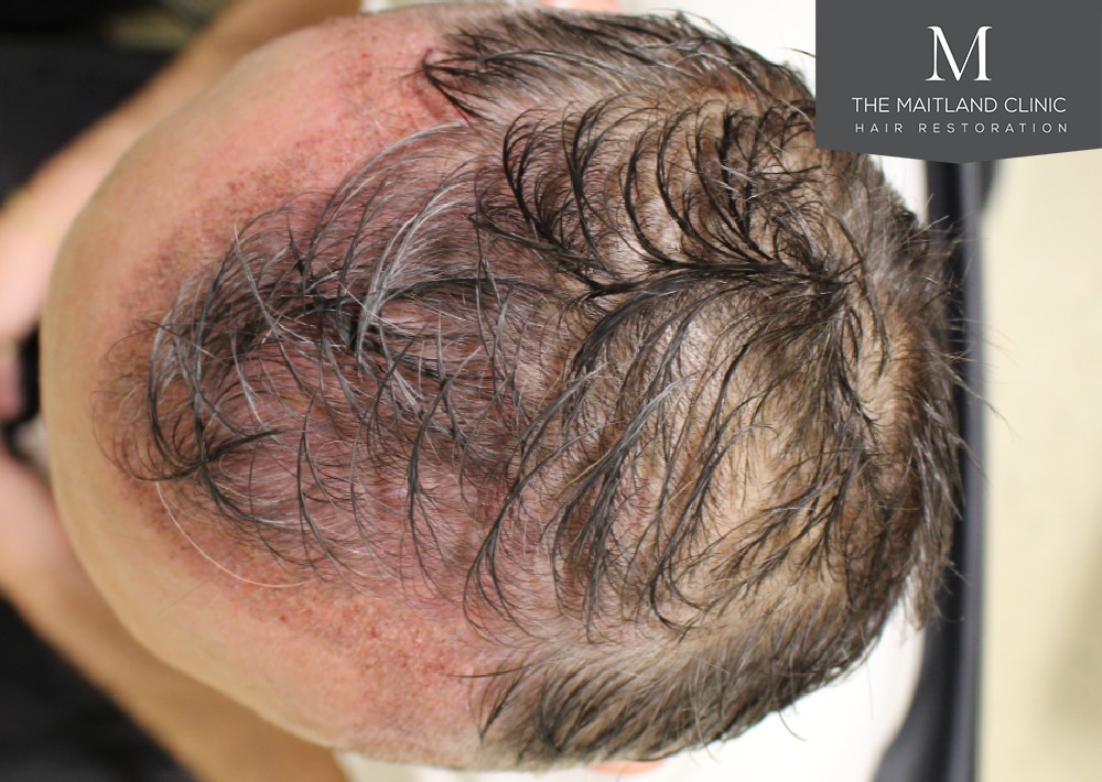 3487 grafts by FUE over 2 procedures