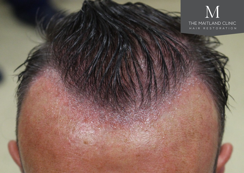 3487 grafts by FUE over 2 procedures