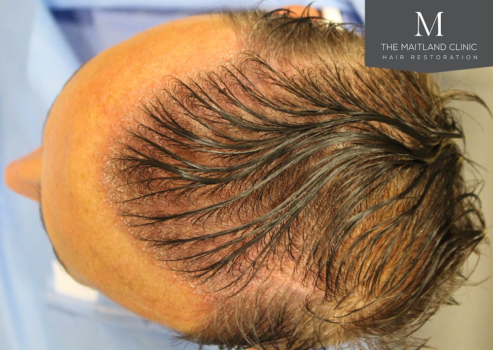 3487 grafts by FUE over 2 procedures