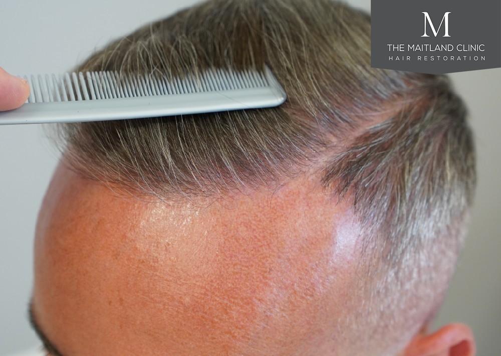 3487 grafts by FUE over 2 procedures